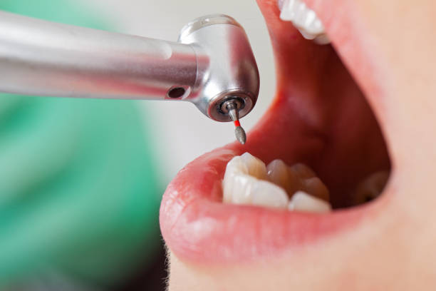 Best Emergency Dental Extractions in Lake Mary, FL